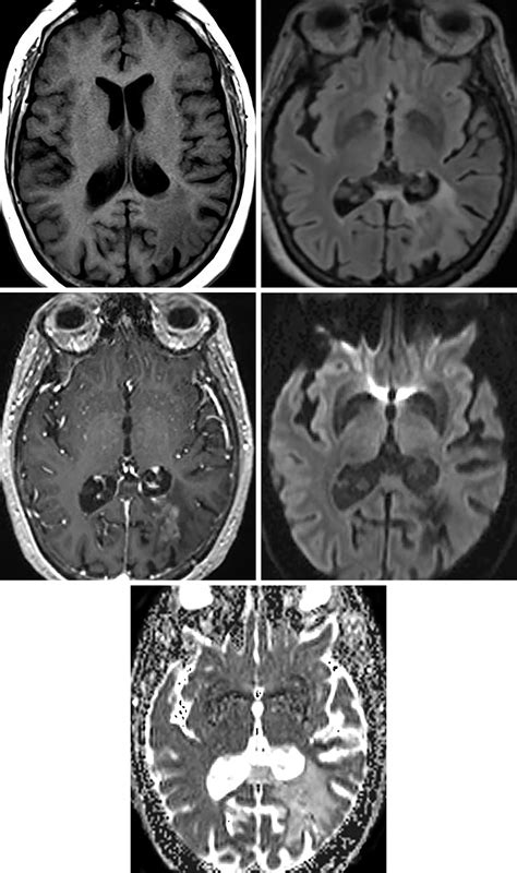 Amyloid Angiopathy Mri Brain