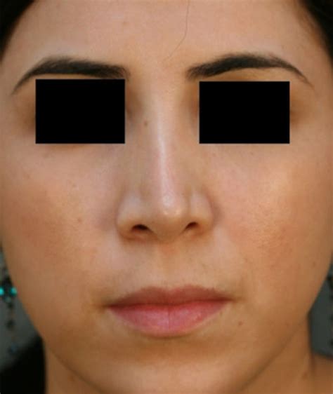 Patient 108189860 Ethnic Rhinoplasty Before And After Photos Nassif