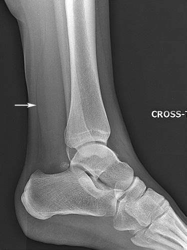 Soft Tissue Signs The Ankle Radiology Radiology Student Radiography