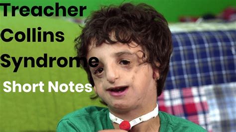 Treacher Collins Syndrome Short Notes YouTube