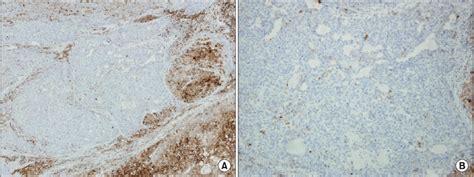 A Epithelial Membrane Antigen Ema Stain Is Negative In Yolk Sac