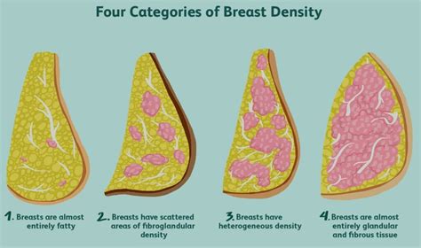 Risk Factors Of Breast Cancer Causes Types Of Breast Cancer