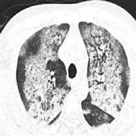 CT scan of lung, axial view, showing bilateral diffuse perihilar... | Download Scientific Diagram