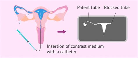 Blocked Fallopian Tubes Causes Diagnosis And Treatment