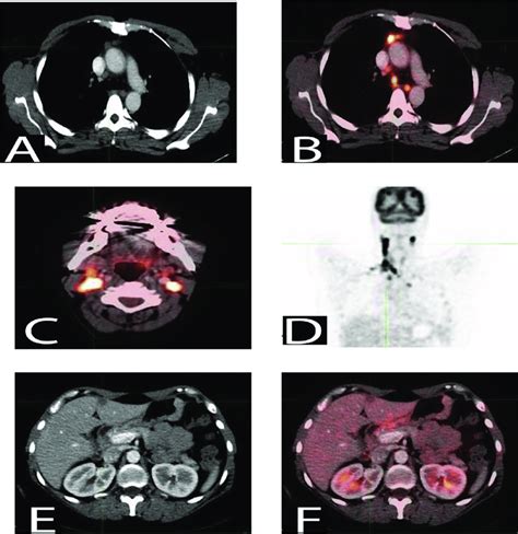 F Fdg Pet Ct Image Of Year Old Male Patient Month After The