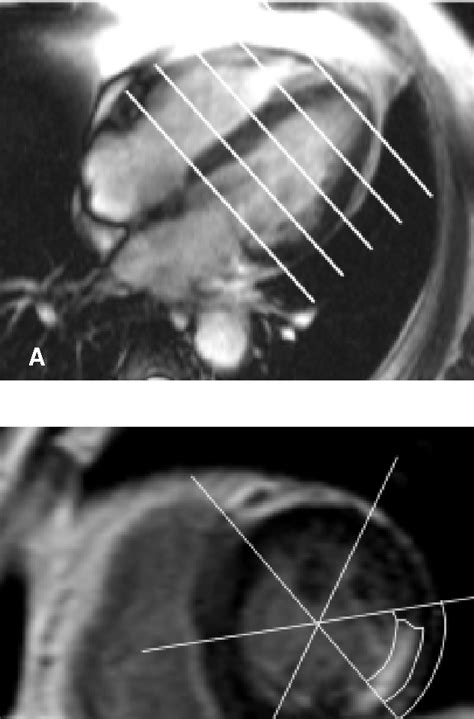 Figure From Early Assessment Of Myocardial Contractility By Contrast