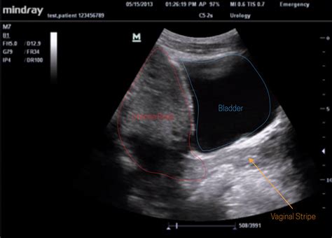 Ultrasound Leadership Academy The Basics Of Pelvic Transabdominal