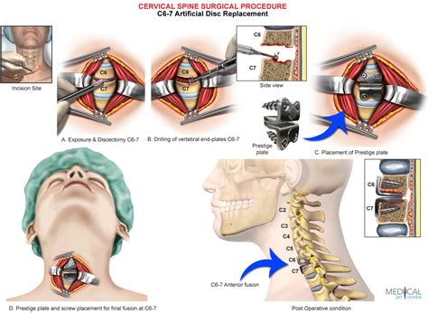 Cervical Disc Replacement Procedure