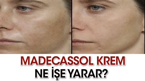 Madecassol Krem Ne I E Yarar