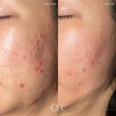 Tca Cross With Co Laser A Powerful Combination For Acne Scars