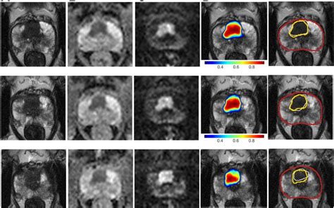 Prostate Cancer Ai Blog