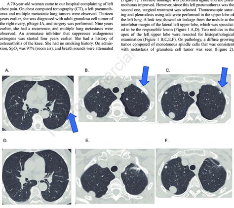 Chest Ct Findings Before And After Video Assisted Thoracoscopic Vats Download Scientific