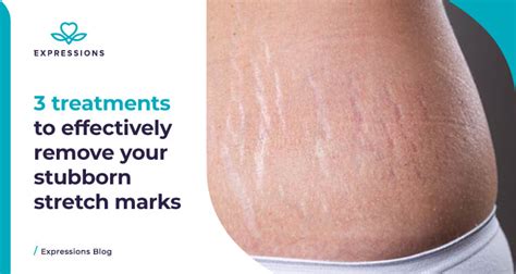 3 Treatments To Effectively Remove Your Stubborn Stretch Marks Expressions Aesthetics And Slimming