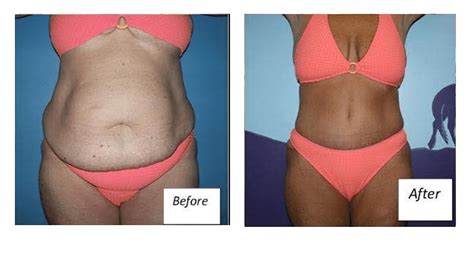 Tummy Tuck And Liposuction