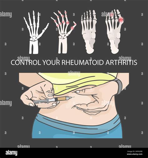 CONTROL DE LA ARTRITIS REUMATOIDE Inyección hipodérmica en el estómago