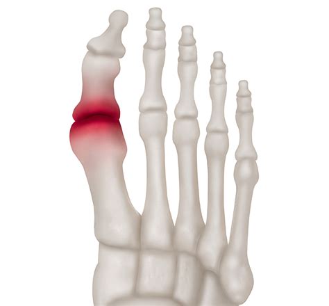 Injured Big Toe Joint