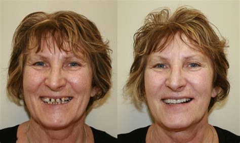 Composite Veneers Melbourne Composite Bonding Resin Veneers Melbourne