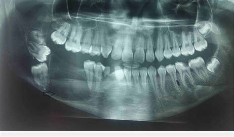 Orthopantomogram Showing A Well Defined Unilocular Radiolucent Lesion