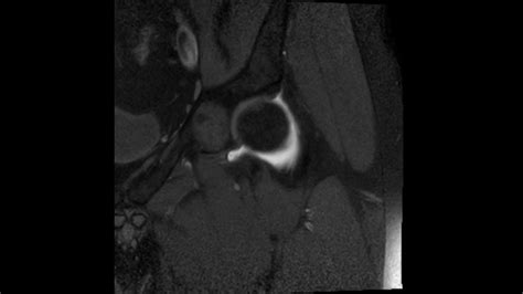 Transient Osteoporosis Of The Hip Complete Mri Examination Youtube