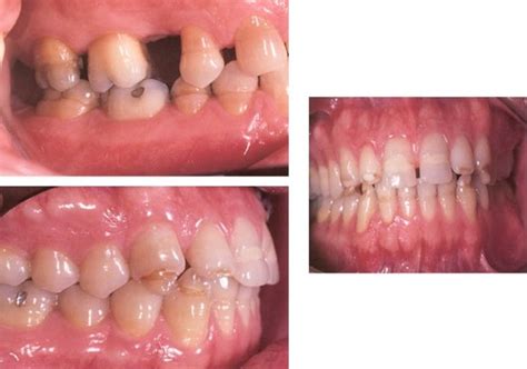 Abnormalities Of Teeth Flashcards Quizlet