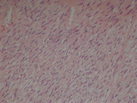 Spindle Shaped Tumor Cells With Elongated Nuclei And Eosinophilic