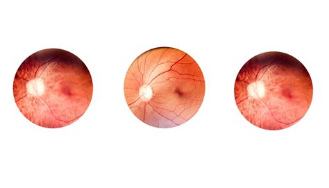 Diabetic Retinopathy: Causes, Symptoms, Diagnosis & Treatment