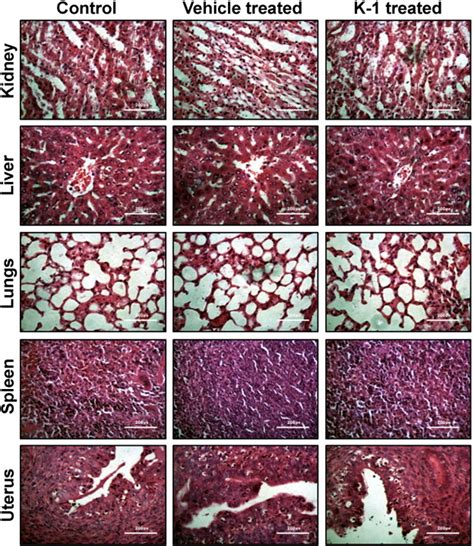 Anti Tumorigenic Action Of 2 Piperidinoethoxyphenyl 3 4