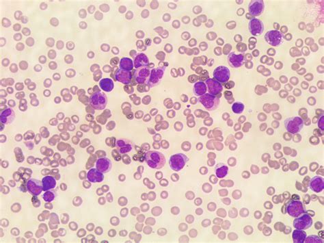 Peripheral blood smear at diagnosis | Download Scientific Diagram