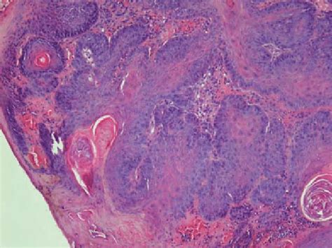 Histological Presentation Of Squamous Papilloma Tumour 4 Hematoxylin