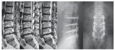 Scielo Brasil Surgical Vs Conservative Treatment For Degenerative