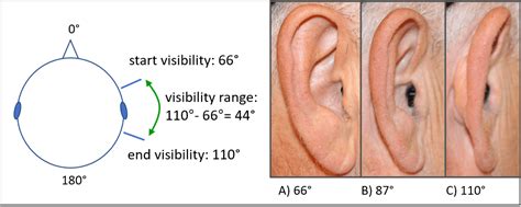 Novel Benefits in CROS and BiCROS Hearing Aid Fitting Technology