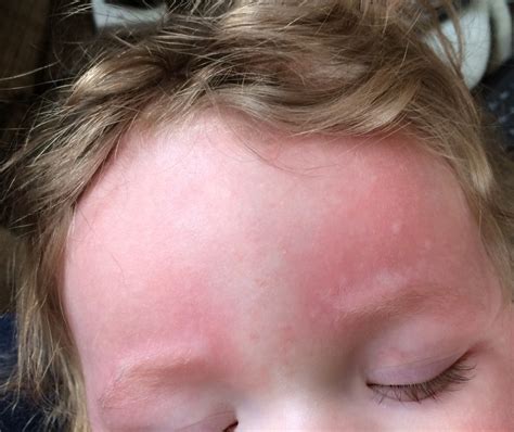 Fear and frustration: Why is my baby covered head to toe in hives ...