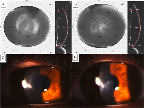 Severe Long Term Progressive Corneal Remodeling After Bilateral