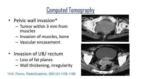 Imaging In Diagnosis And Treatment Of Carcinoma Cervix