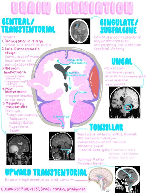 Brain herniation notes – Artofit