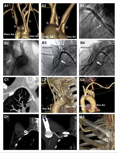 Figure From Simultaneous Congenital Anomaly Stenosis And