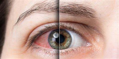 Alcoholic Eyes: Identifying and Treating Alcoholic Vision Loss - Woods at Parkside