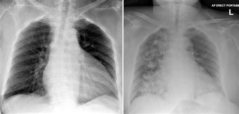 aspiration pneumonia radiology  st vincents university hospital