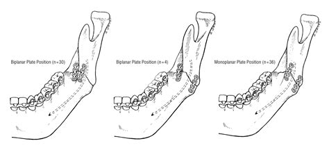 Mandibular Angle Fractures Two Miniplate Fixation And Complications