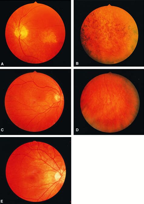 Autosomal Dominant Conerod Retinal Dystrophy Cord From Heterozygous