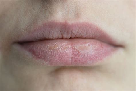 Cold Sore Vs Pimple On Lip How To Identify And Treat