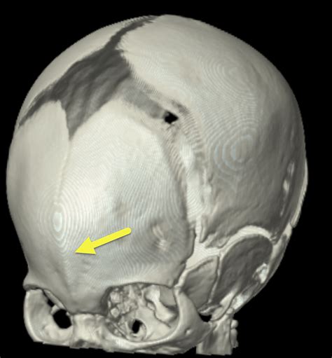 Metopic Suture Craniosynostosis