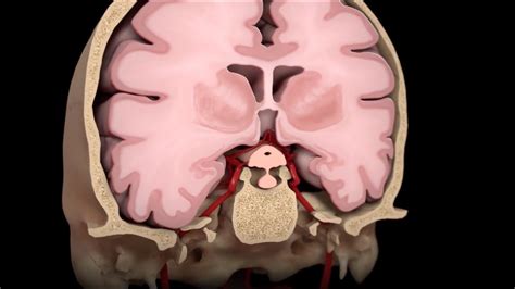 Descubre cómo se ve un aneurisma cerebral síntomas diagnóstico y