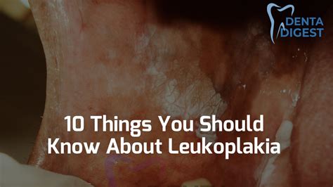 10 Things You Should Know About Leukoplakia In 2023 | Dentadigest