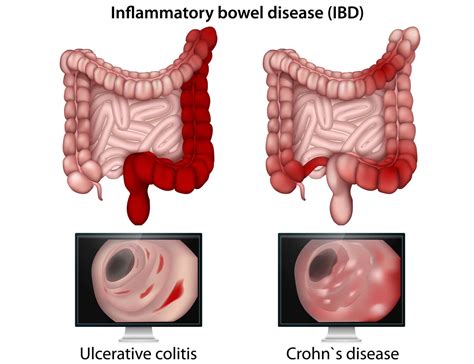 Crohns Disease Stool