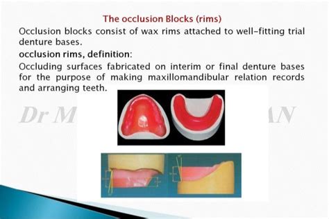 The Occlusal Rims And Record