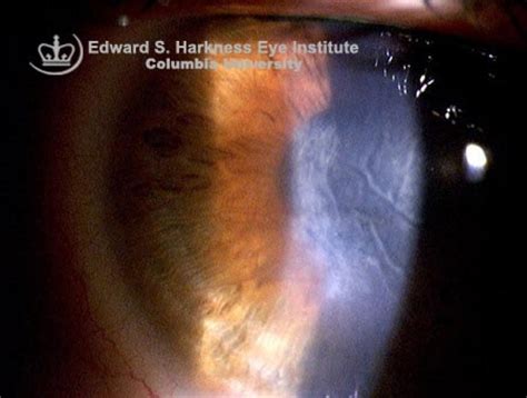 Corneal Edema Vagelos College Of Physicians And Surgeons