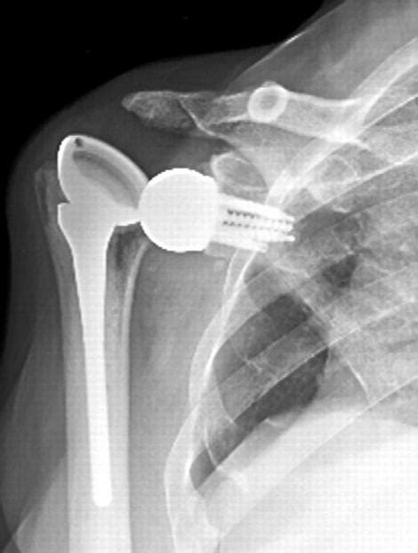 Reverse Shoulder Arthroplasty Shoulder Elbow Orthobullets