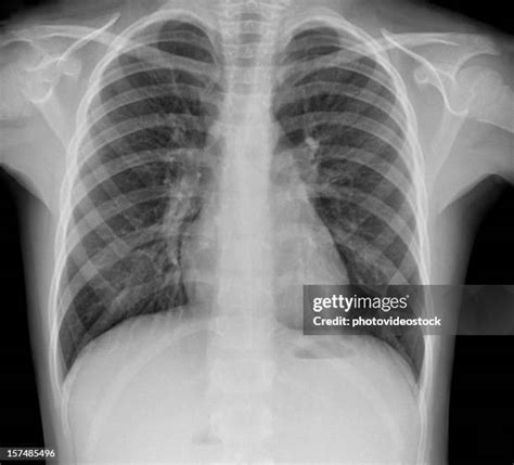 Tuberculosis X Ray Photos and Premium High Res Pictures - Getty Images