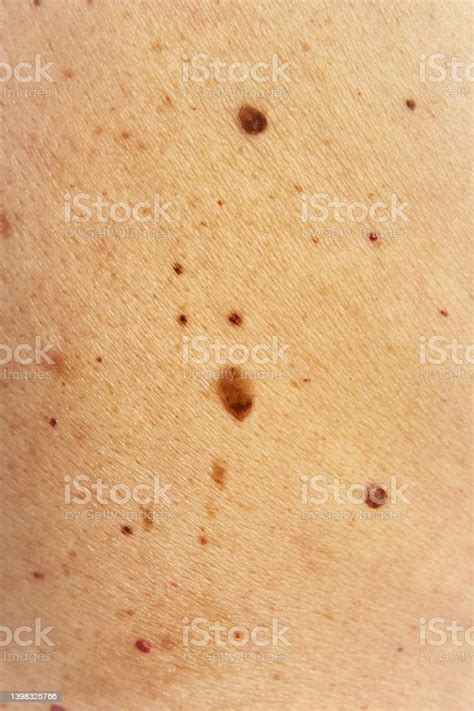 Moles And Birthmark On Human Skin Stock Photo Download Image Now